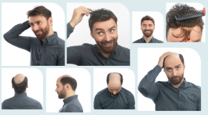 قبل و بعد از استفاده از پروتز مو برای آقایان با درجات مختلف طاسی