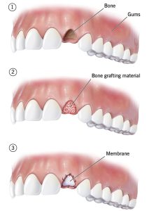 Bone grafting procedure in dentistry | ایران کارن
